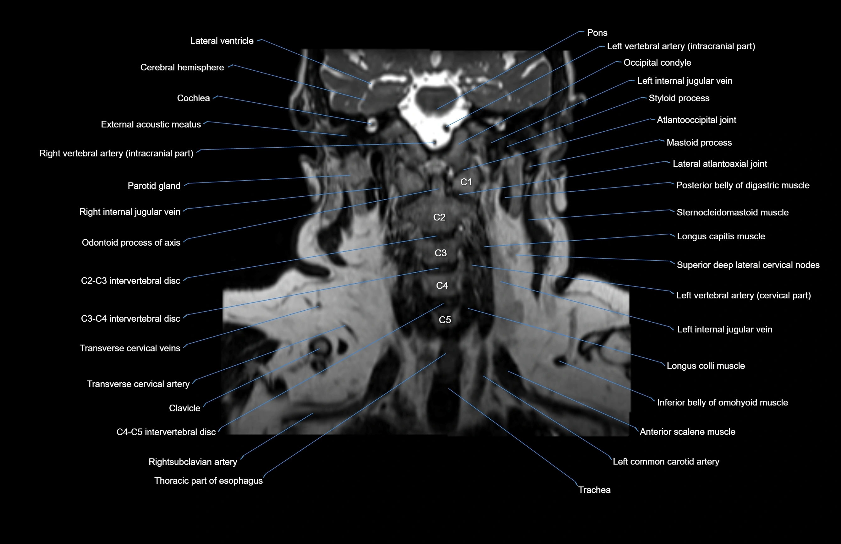 Neck coronal cross sectional MRI anatomy 3T MRI  image-img-00001-00032.webp